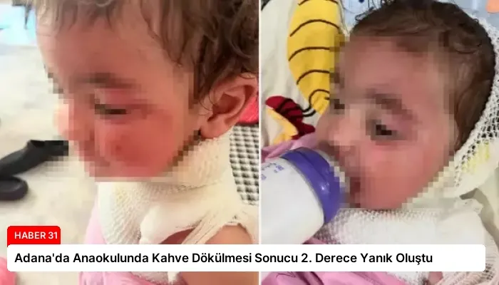 Adana’da Anaokulunda Kahve Dökülmesi Sonucu 2. Derece Yanık Oluştu
